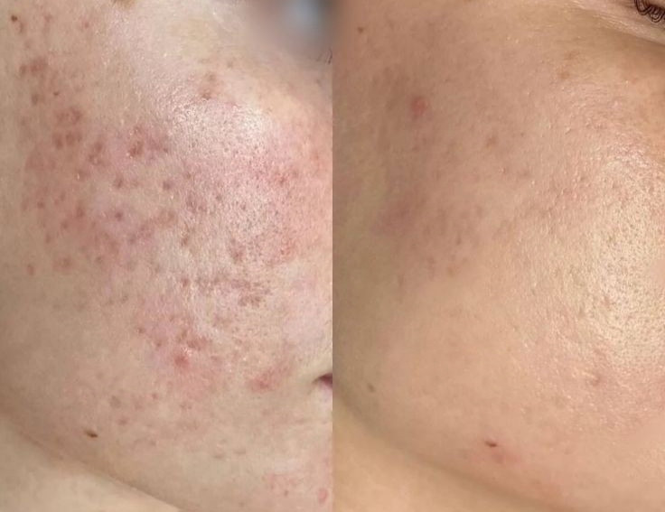 آموزش،دوره اسیدتراپی(پیلینگ شیمیایی)