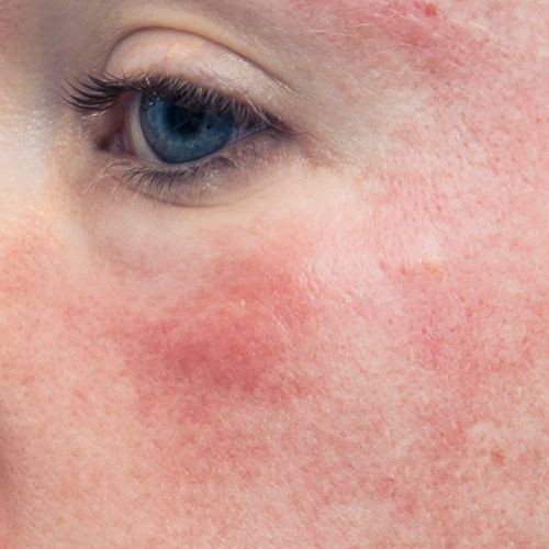 آموزش،دوره مجازی پاکسازی،فیشال پوست و مو