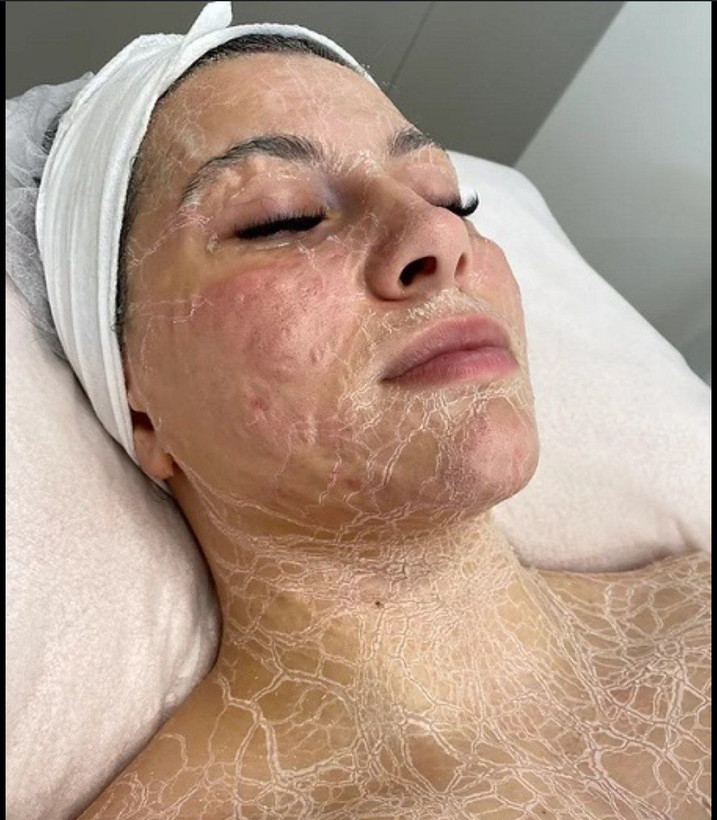 دوره آموزشی شبه بوتاکس(پپتایدتراپی)